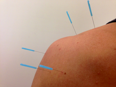 Needling